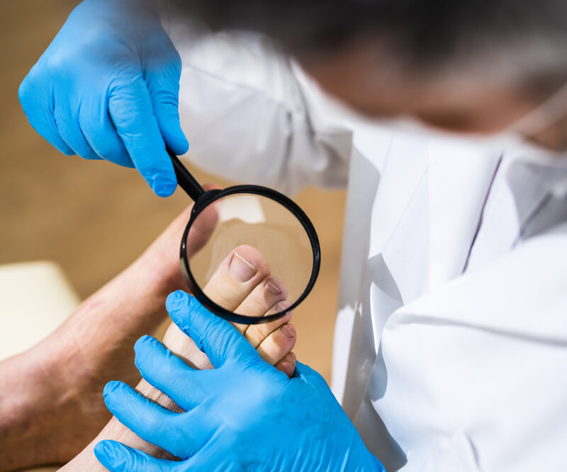 What causes an ingrown toenail? 6 Causes to Watch Out For