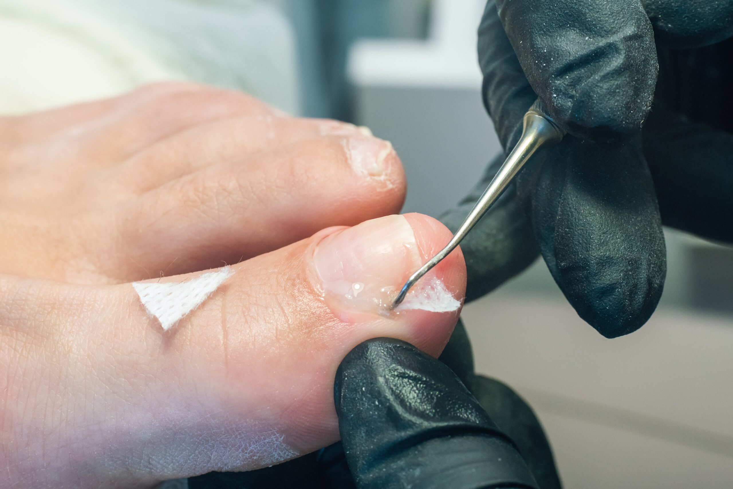 How to Fix an Ingrown Toenail: A Complete Guide to Treatment and Preventive Care