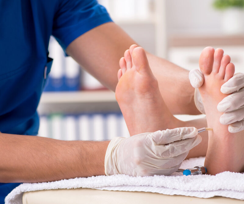 How to get rid of calluses on feet? 4 Professional Treatment Options